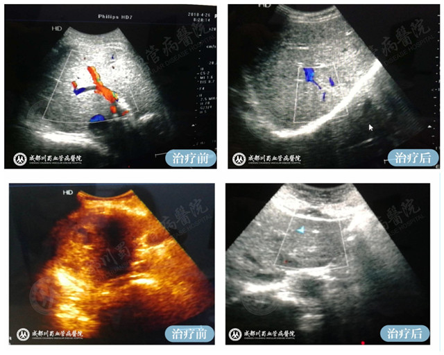 【成都血管瘤治疗案例】智能腔内综合治疗前后对比12