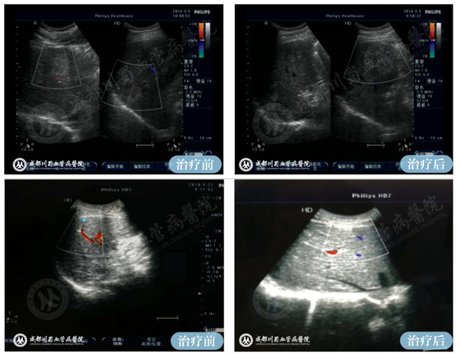 【成都血管瘤治疗案例】智能腔内综合治疗前后对比9