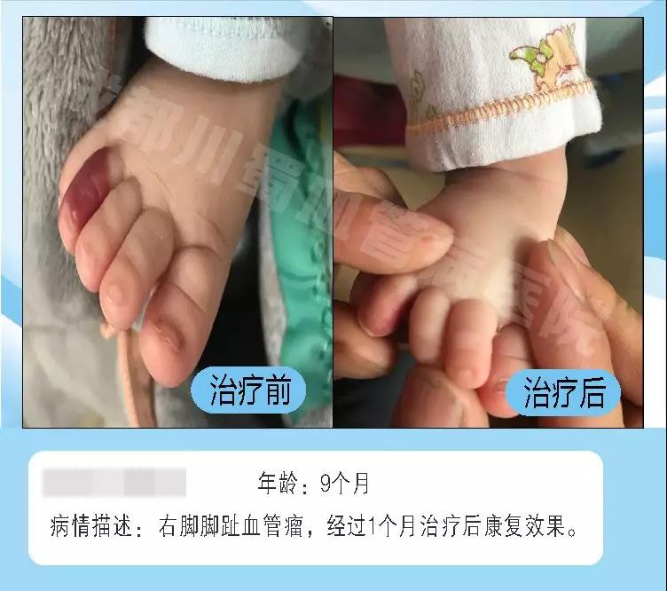 血管瘤是胎记吗,血管瘤不治疗会怎样,成都治疗血管瘤医院