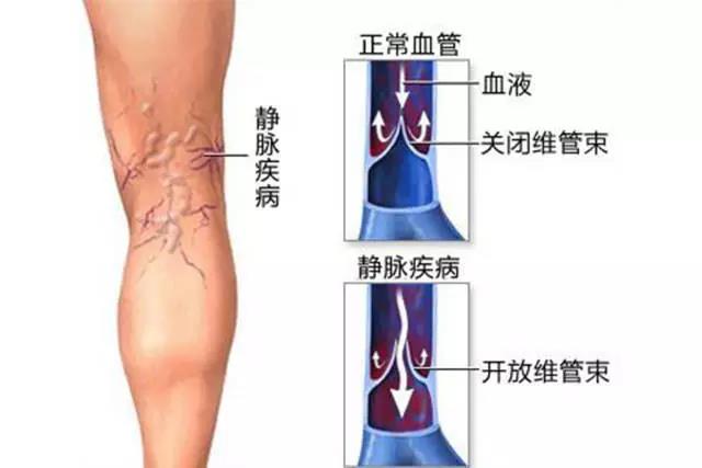 腿上有青筋是怎么回事,静脉曲张怎么彻底治疗,成都川蜀血管病院