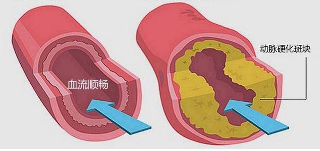 下肢动脉硬化闭塞症,成都川蜀血管病医院