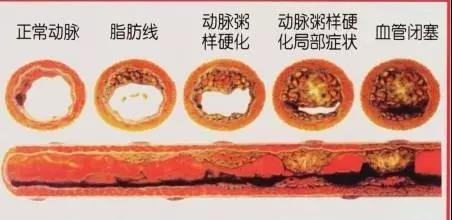 下肢动脉硬化闭塞症,动脉硬化,成都川蜀血管病医院